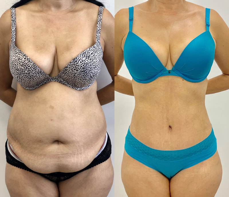 tummy tuck  - before & after 20