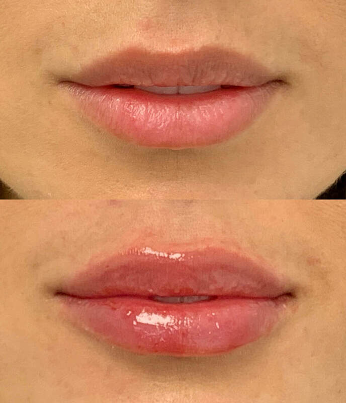 Lip Injection - Before & After 2