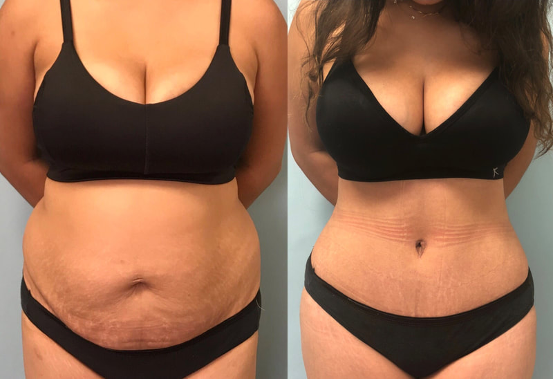 tummy tuck  - before & after 22