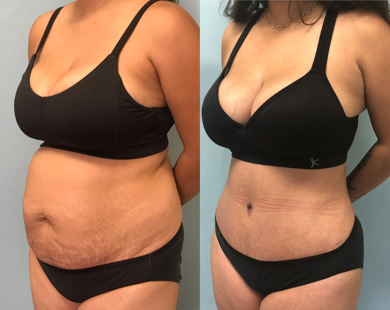tummy tuck  - before & after 23