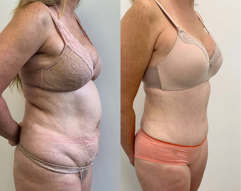 tummy tuck  - before & after 26