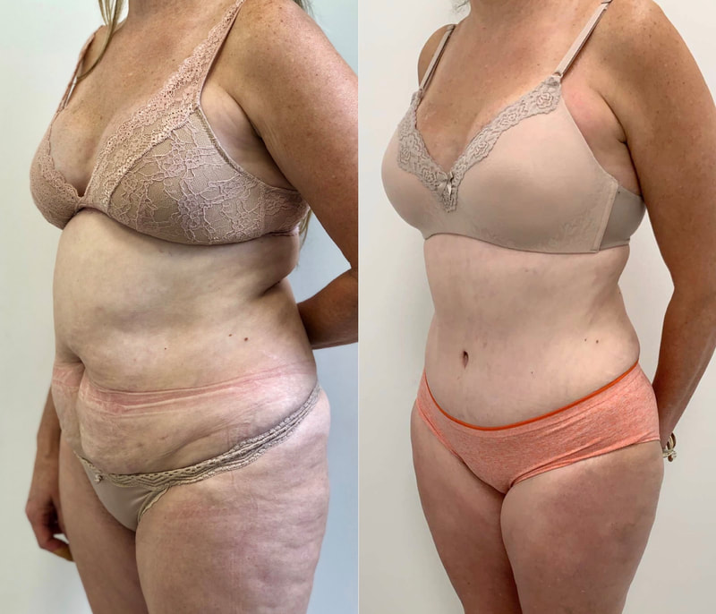 tummy tuck  - before & after 27