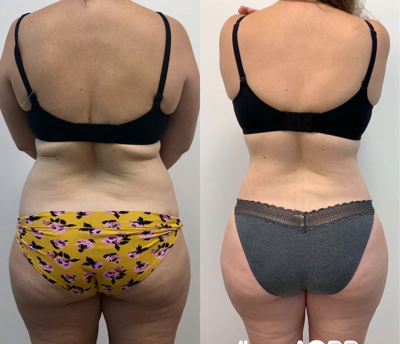 tummy tuck  - before & after 2