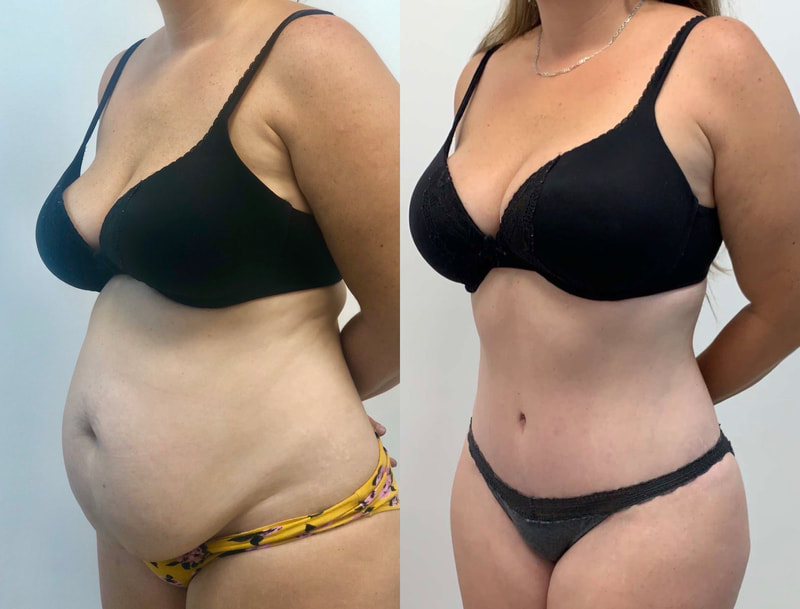 tummy tuck  - before & after 3