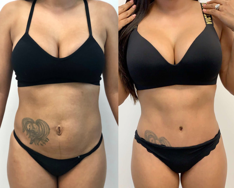 tummy tuck  - before & after 28