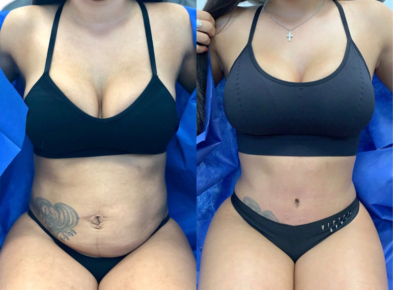 tummy tuck  - before & after 30