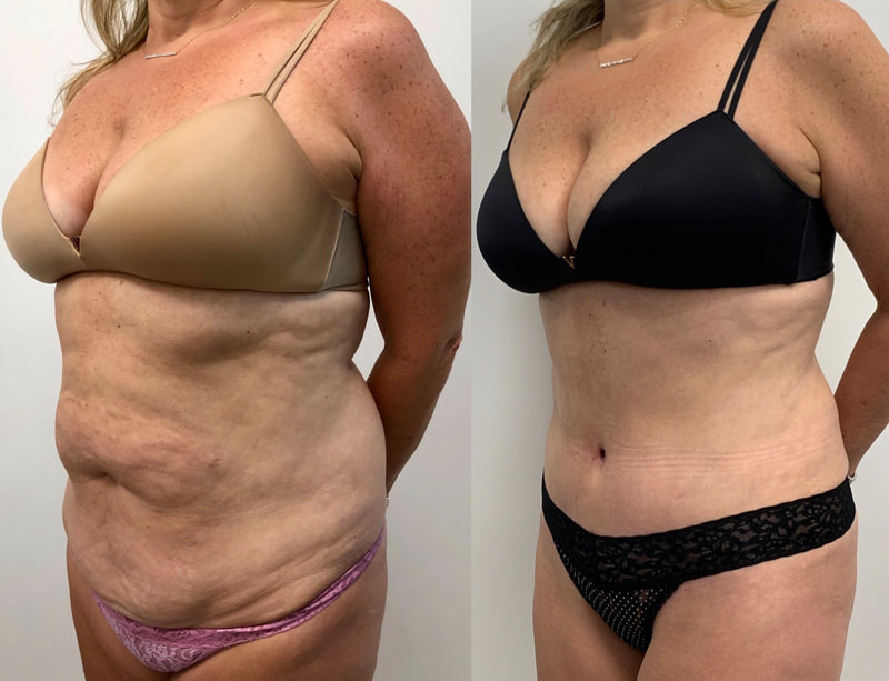 tummy tuck  - before & after 31