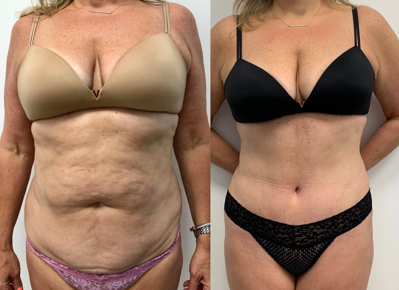 tummy tuck  - before & after 32