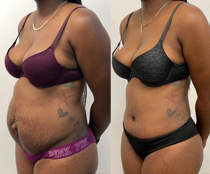 tummy tuck  - before & after 33