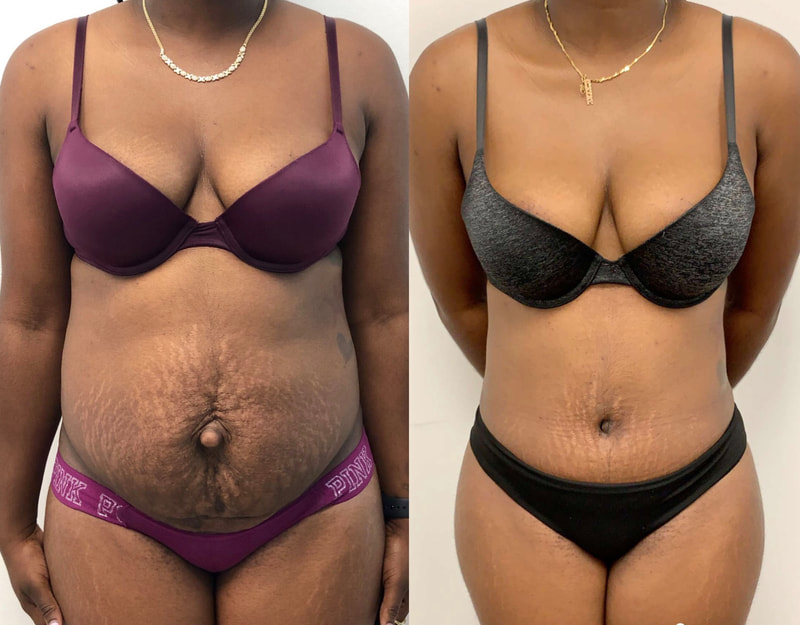 tummy tuck  - before & after 34