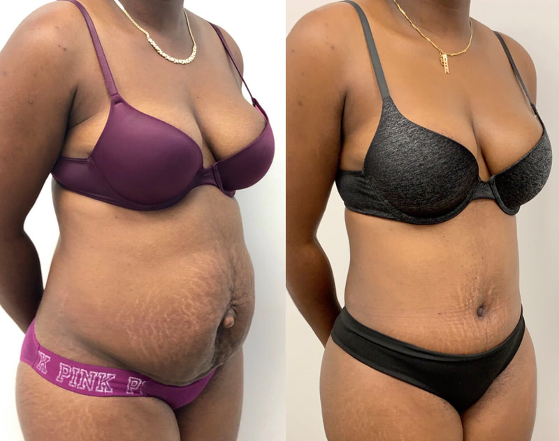 tummy tuck  - before & after 35