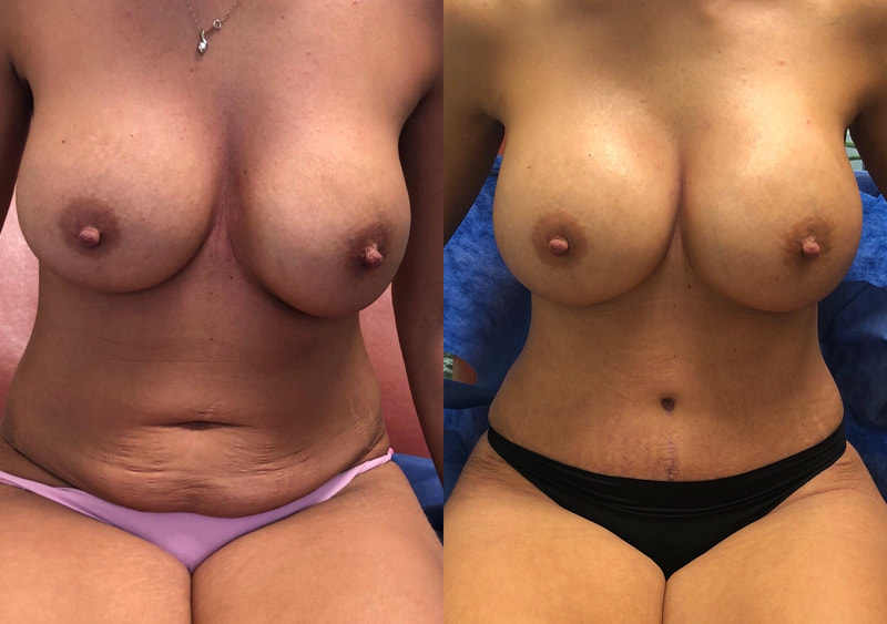 tummy tuck  - before & after 36