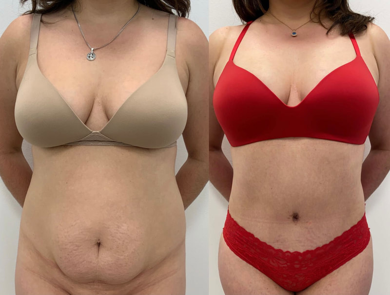 tummy tuck  - before & after 140