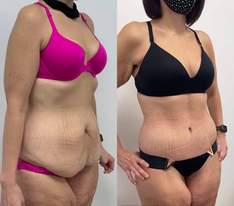 tummy tuck  - before & after 101