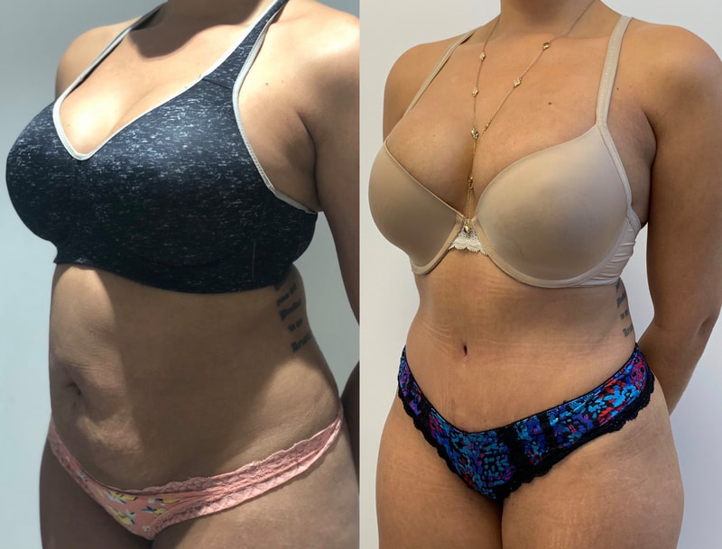 tummy tuck  - before & after 5