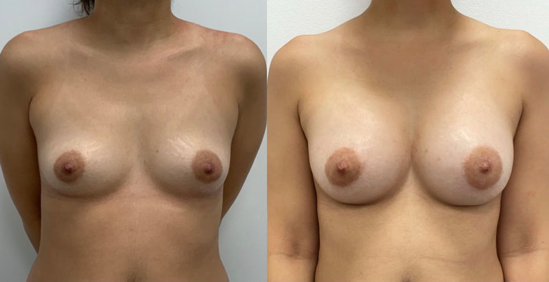 Breast implant before & after 129