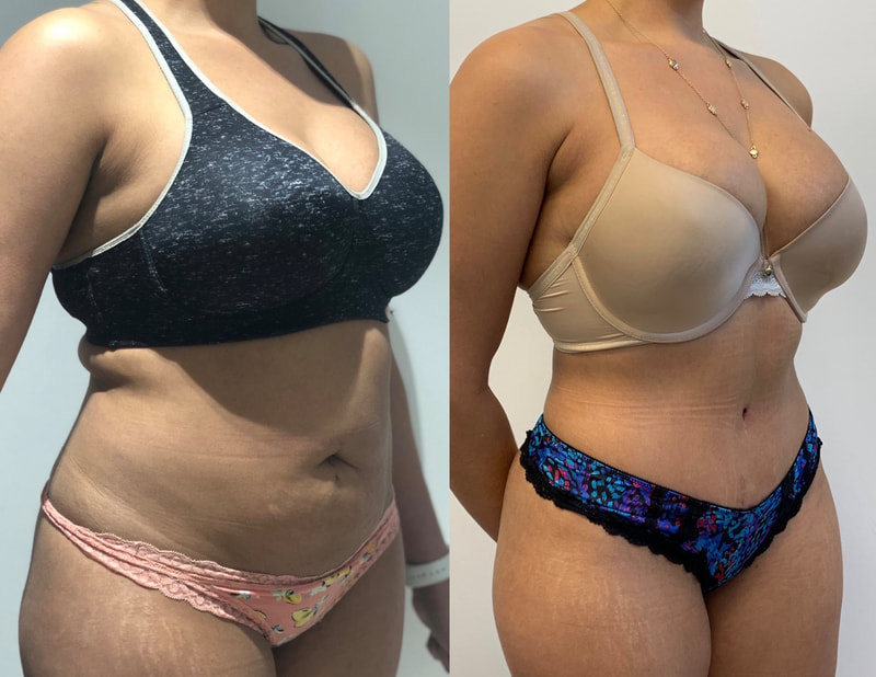 tummy tuck  - before & after 6