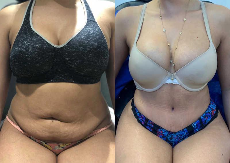 tummy tuck  - before & after 7