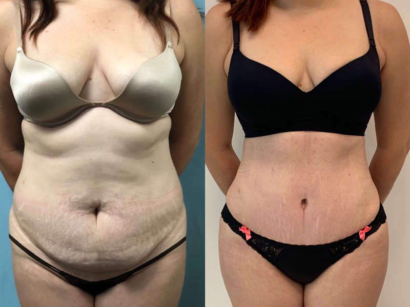 tummy tuck  - before & after 5