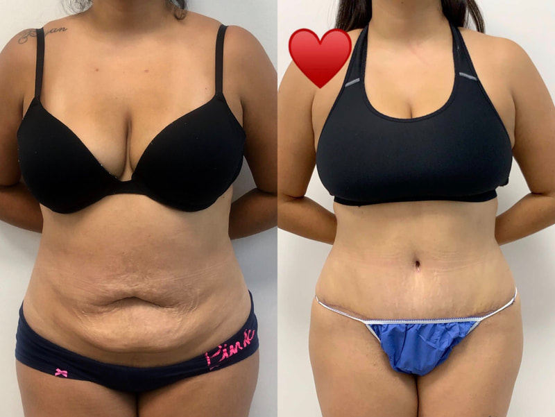 tummy tuck  - before & after 38