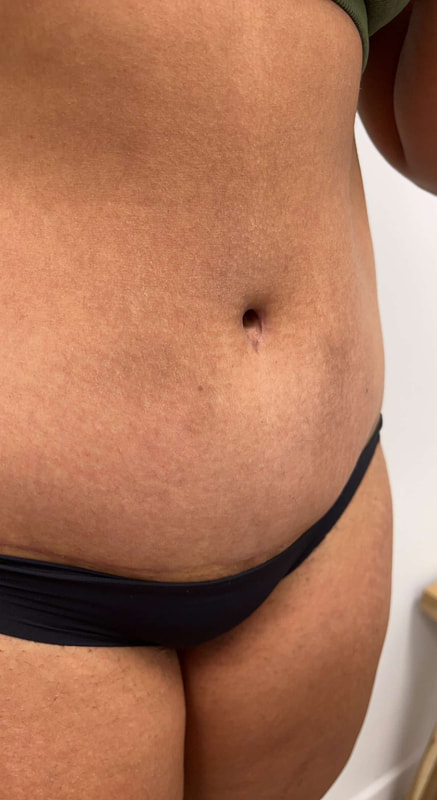 Dr. Oppenheimer - Belly Button After Tummy Tuck