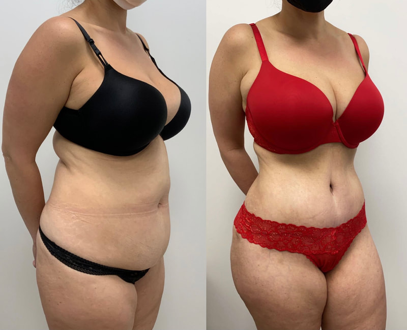 tummy tuck  - before & after 134
