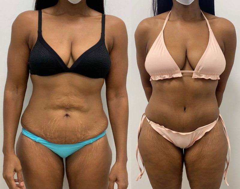 tummy tuck  - before & after 136