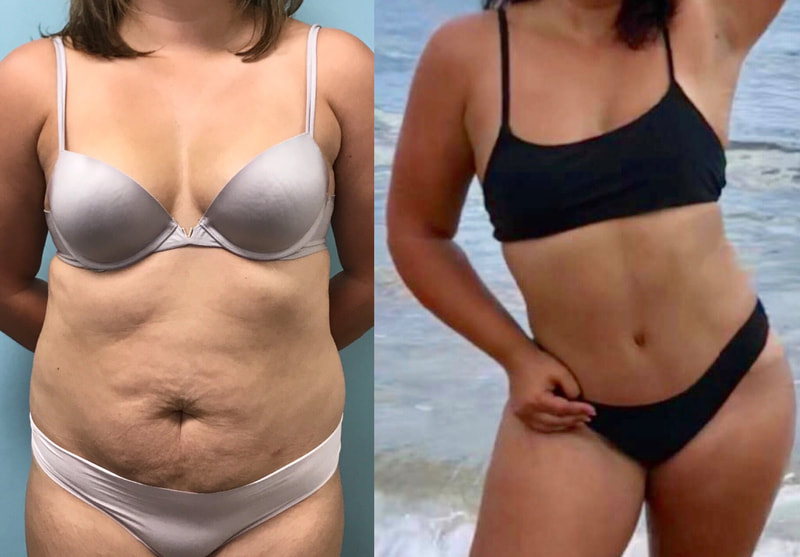 tummy tuck  - before & after 39