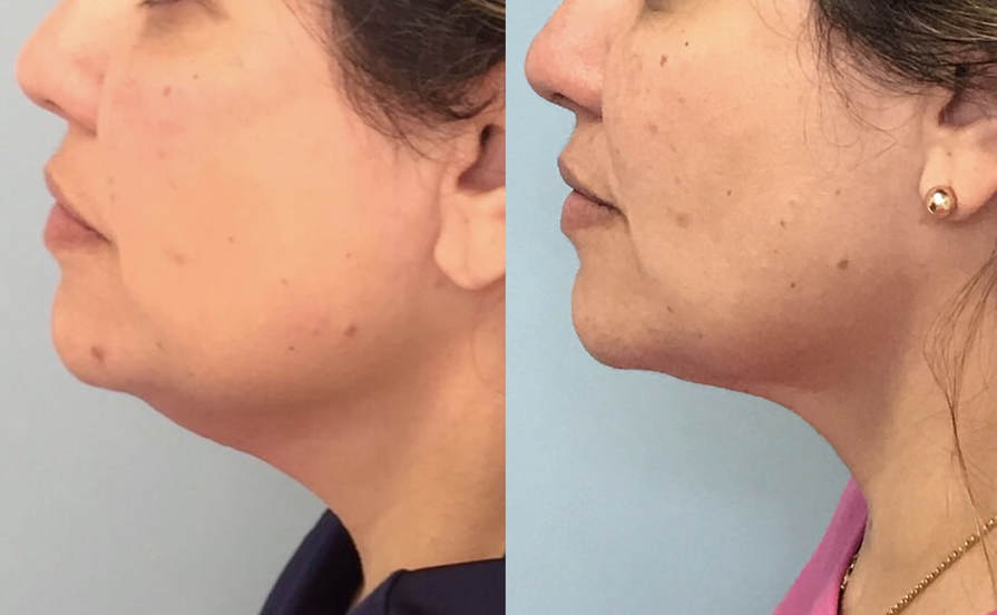 Facial Lipo Before & After 3