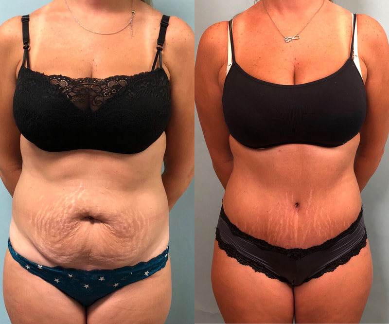 tummy tuck  - before & after 40