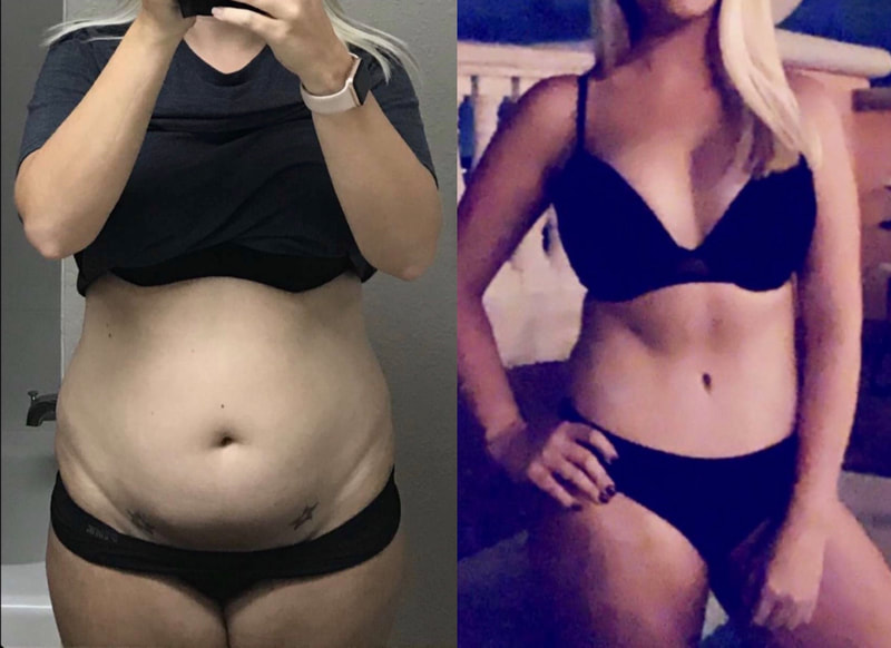 tummy tuck  - before & after 41
