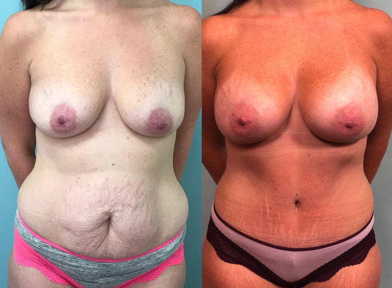 tummy tuck  - before & after 42