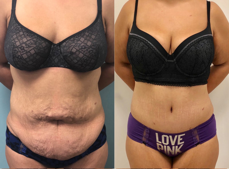 tummy tuck  - before & after 43
