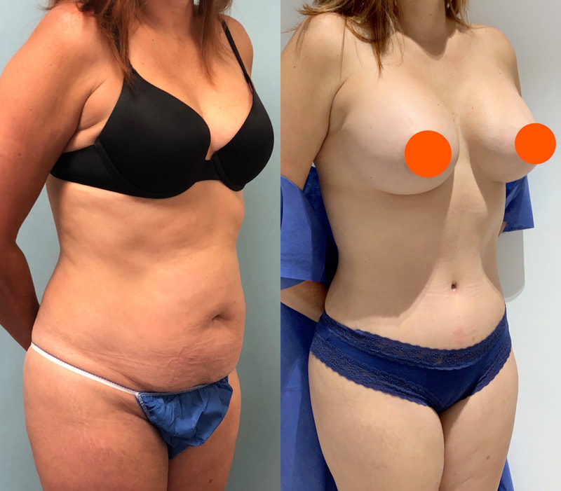 tummy tuck  - before & after 46