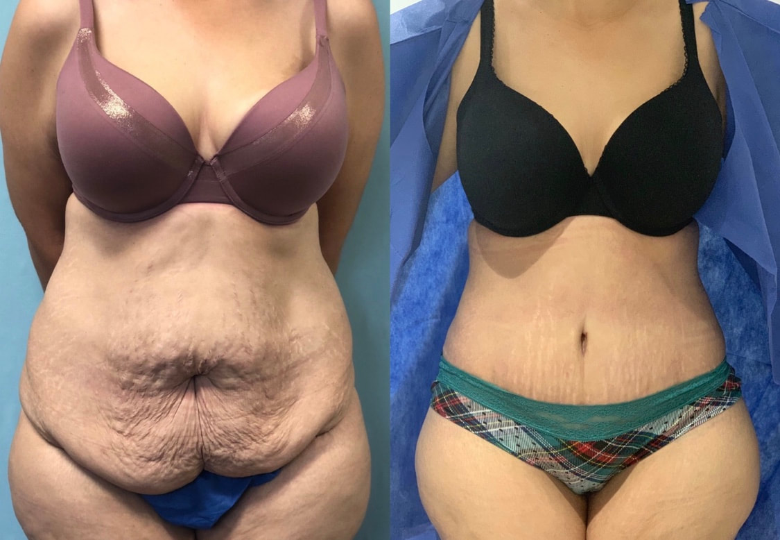 tummy tuck  - before & after 47