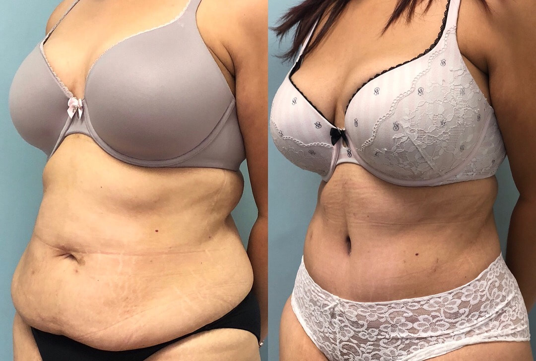 tummy tuck  - before & after 48