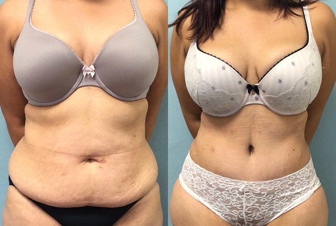 tummy tuck  - before & after 49