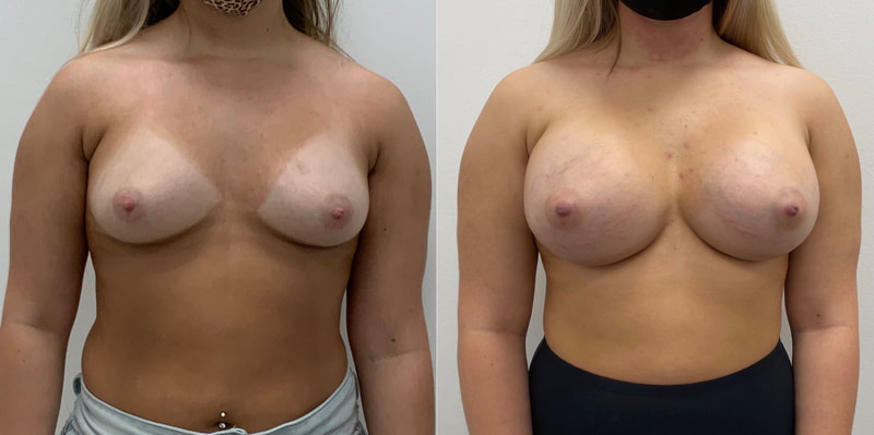 Breast implant before & after 113