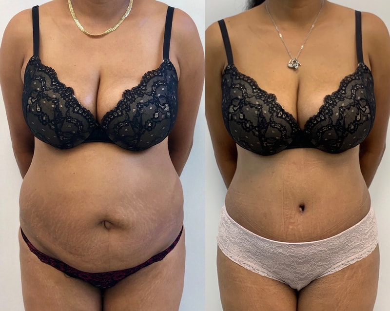 tummy tuck  - before & after 7