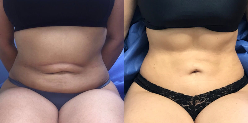 tummy tuck  - before & after 50