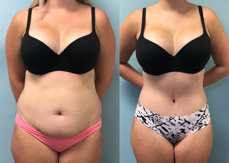 tummy tuck  - before & after 51