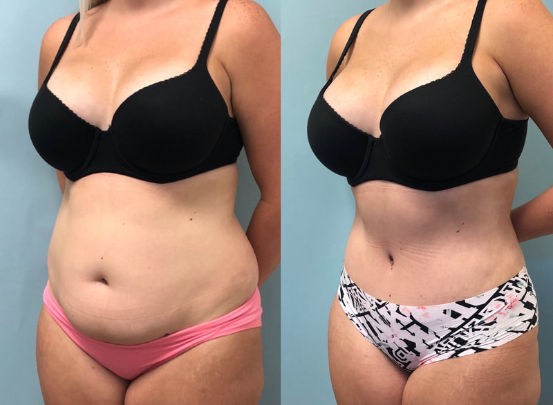 tummy tuck  - before & after 52
