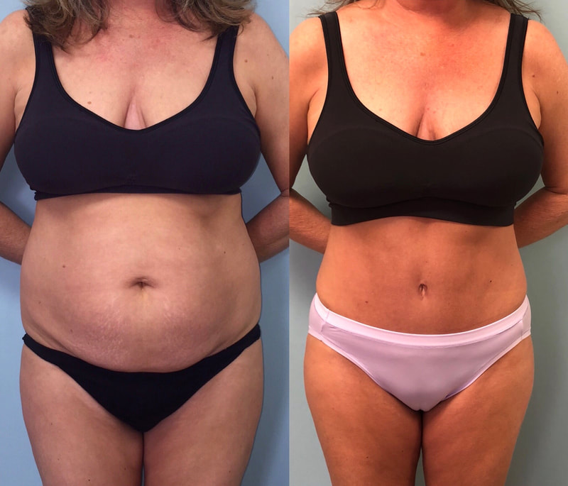 tummy tuck  - before & after 53