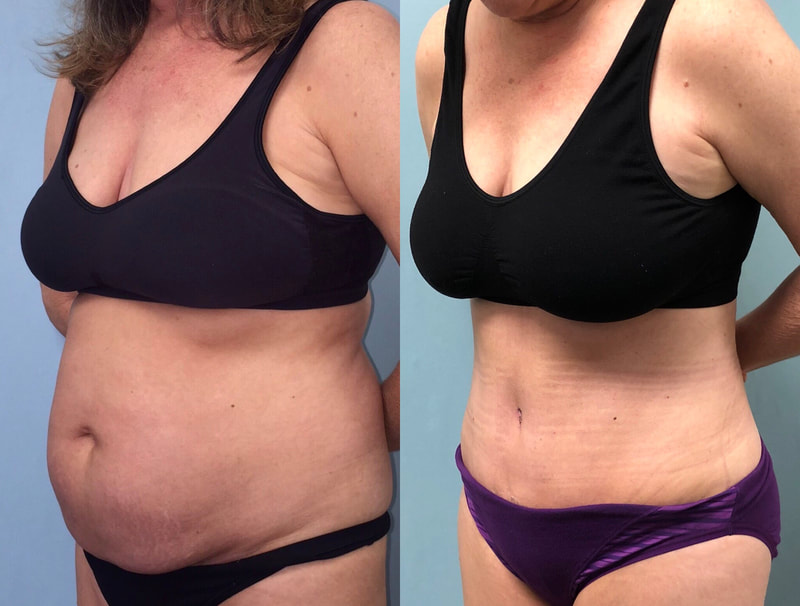 tummy tuck  - before & after 54