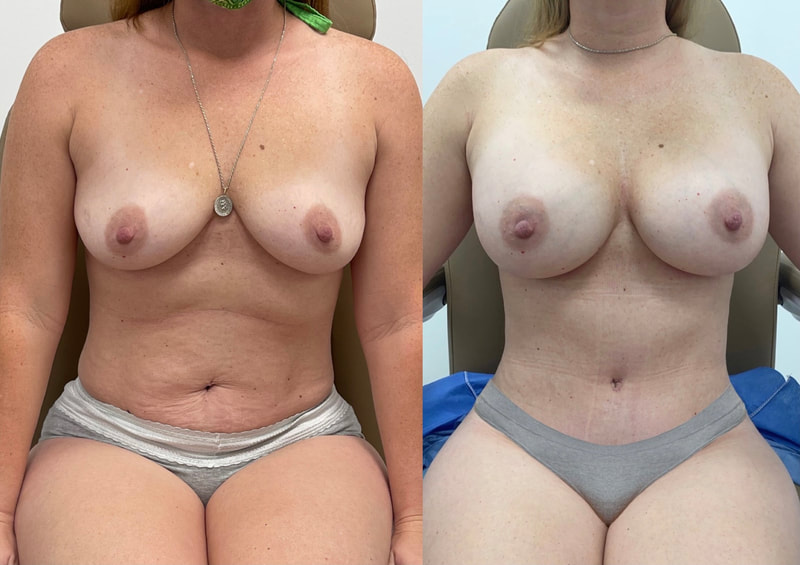 tummy tuck  - before & after 132