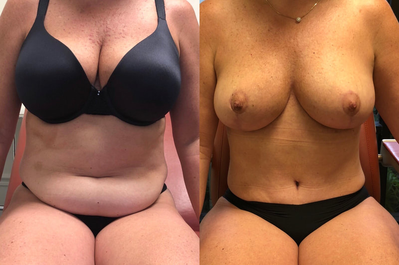 tummy tuck  - before & after 55