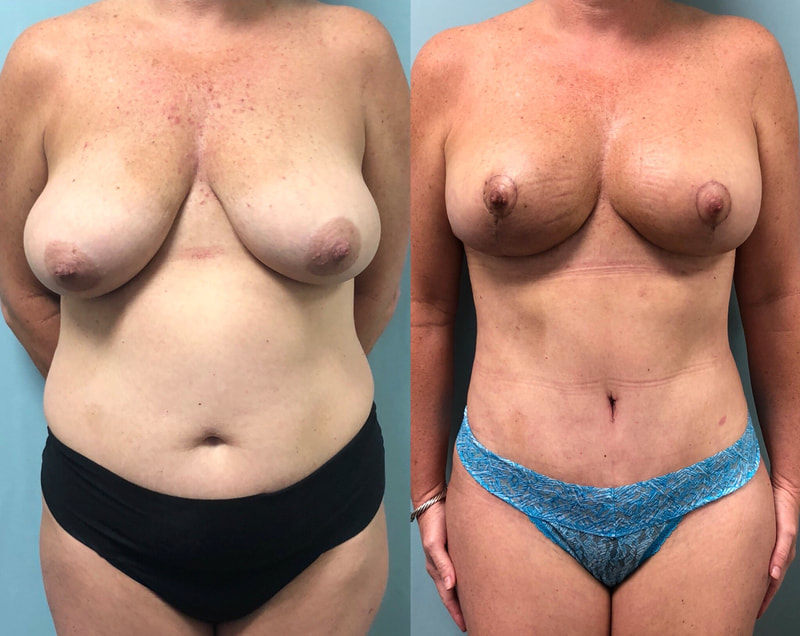 tummy tuck  - before & after 56