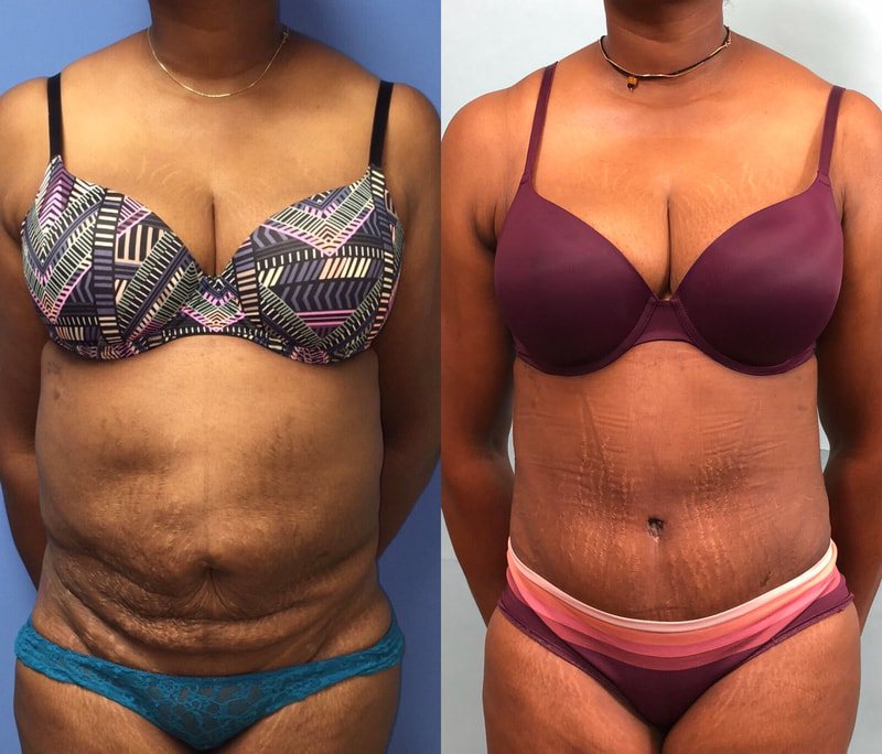 tummy tuck  - before & after 57