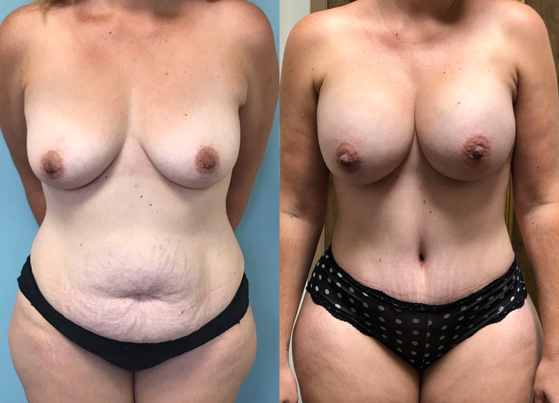 tummy tuck  - before & after 58