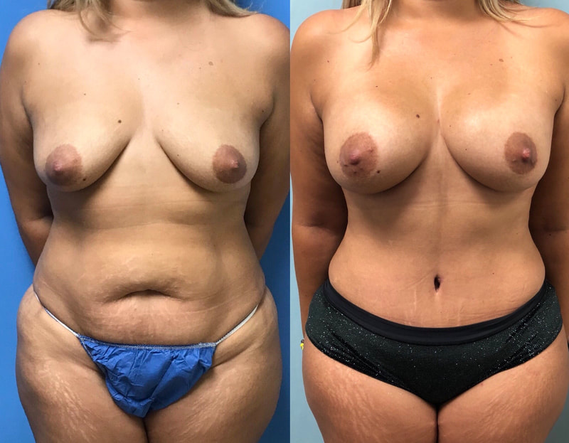 tummy tuck  - before & after 59